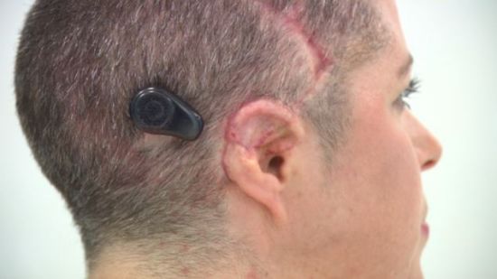 无耳女子装助听器35年后首次听到自己声音图
