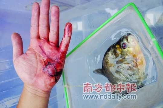 广西柳州的张先生，手掌被食人鱼咬得血肉模糊。