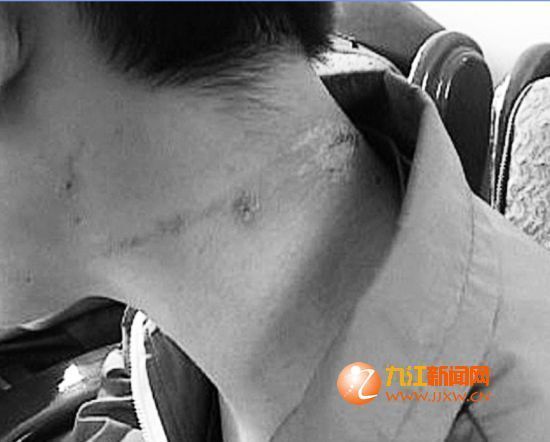 中学近百名学生被隐翅虫咬伤(图)