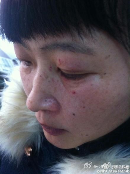 女公交司机被男子连打8拳致鼻骨骨折满脸血(图)