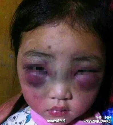 女童遭父母家暴虐待致双眼浮肿变形(图)