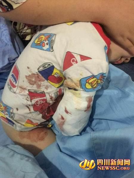 四川大学华西医院了解到,该院昨日收治了一名被老虎咬伤右臂的2岁男孩
