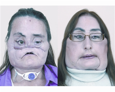 美首名"换脸"人术后露真容