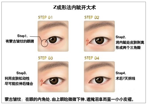 科技明眸指南 揭秘四种热门开眼角术