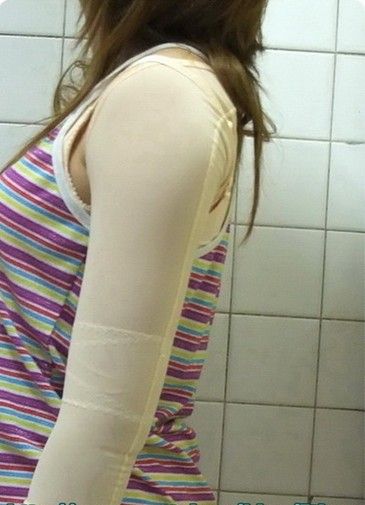 抽脂前后对比网友手臂抽脂全过程