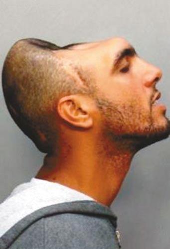 美国"半脑哥"爆红网络 头部只剩半个脑袋(图)